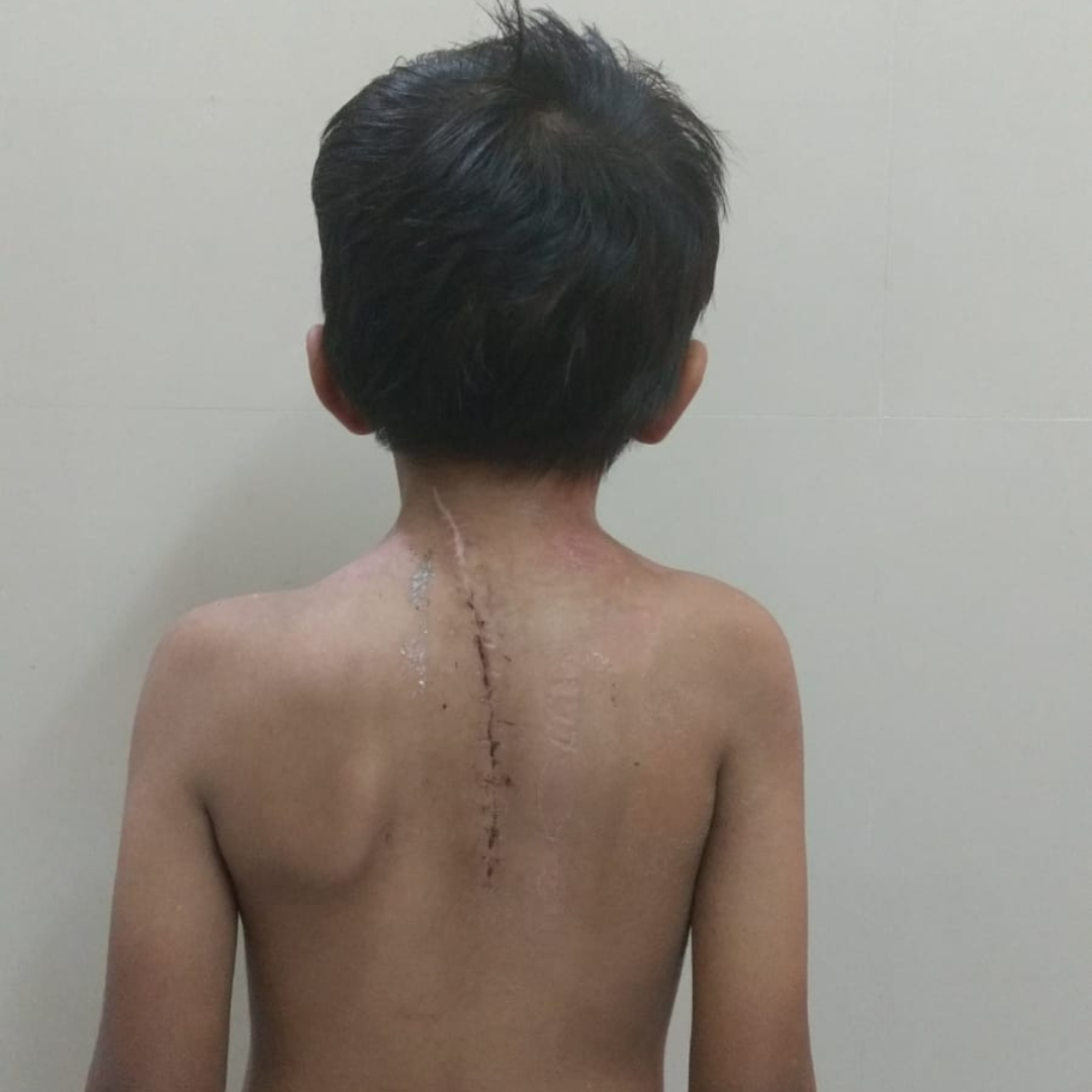 Paediatric Musculoskeletal Disease after surgery image at sankalp orthoclinic nashik by dr. nikhil challawar