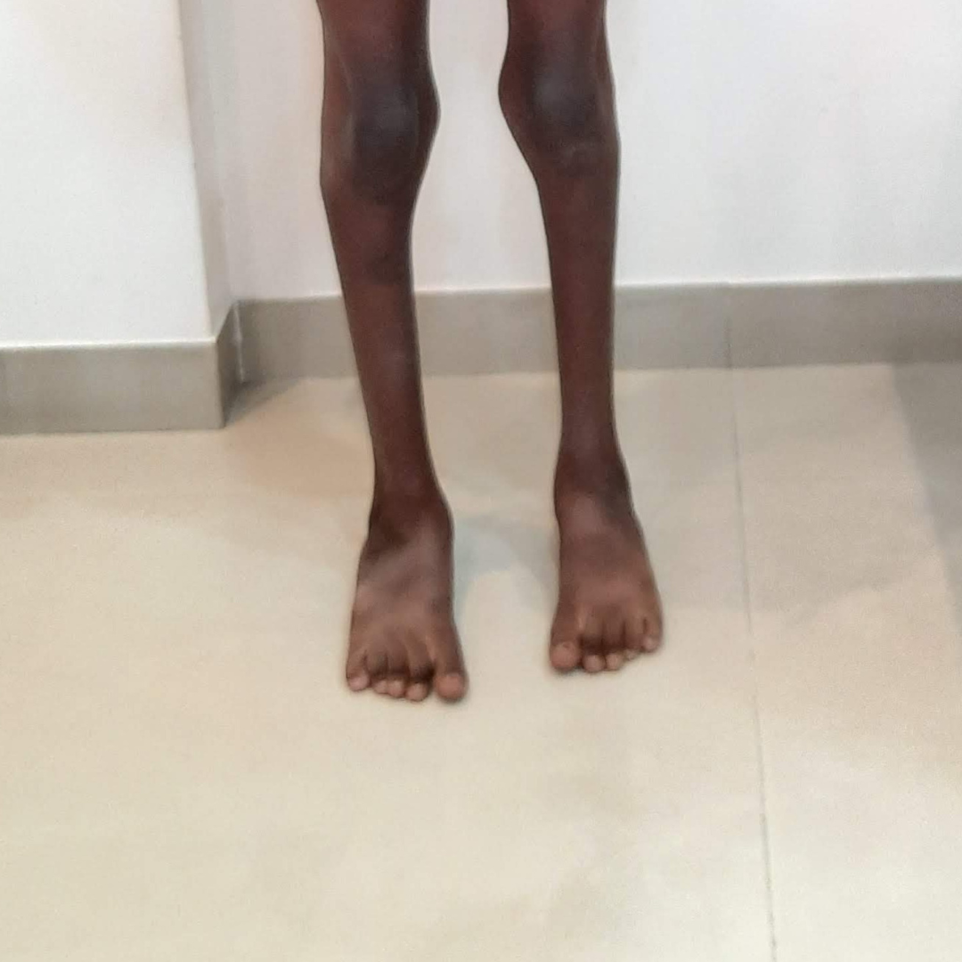 after image of Club Foot 9 Year Old Boy At Sankalp Ortho clinic mumbai naka Nashik by Dr. Nikhil Challawar