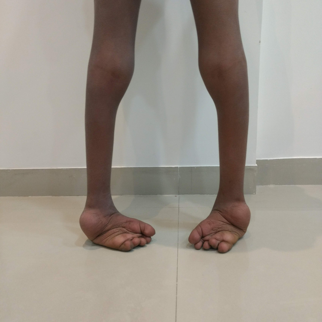 before image of Club Foot 9 Year Old Boy, At Sankalp Ortho clinic Nashik by Dr. Nikhil Challawar